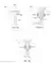 Fig. 37 - METHODS AND ELECTRODE APPARATUS TO ACHIEVE A CLOSURE OF A LAYERED TISSUE DEFECT