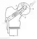 Fig. 01 - Fixation device for treating a bone fracture