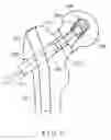 Fig. 05 - Fixation device for treating a bone fracture