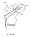 Fig. 11 - Fixation device for treating a bone fracture