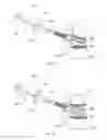 Fig. 07 - Reduced extravasation of bone cement