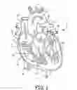 Fig. 02 - SYSTEM AND METHOD FOR RETRIEVAL OF AN IMPLANTABLE MEDICAL DEVICE