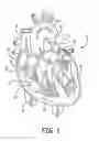 Fig. 02 - System and method for implantation of an implantable medical device