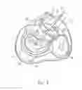 Fig. 03 - Hand operated device for controlled deployment of a tissue anchor and method of using the same