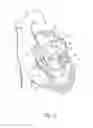 Fig. 06 - Hand operated device for controlled deployment of a tissue anchor and method of using the same