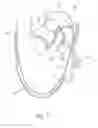 Fig. 08 - Hand operated device for controlled deployment of a tissue anchor and method of using the same