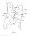 Fig. 10 - Selective tissue removal tool for use in medical applications and methods for making and using