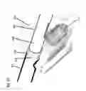 Fig. 16 - System for treating the prostate