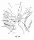 Fig. 22 - System for treating the prostate