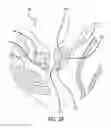 Fig. 27 - System for treating the prostate