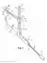 Fig. 02 - Method of performing a suprapubic transurethral cystostomy