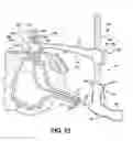 Fig. 09 - Method of performing a suprapubic transurethral cystostomy