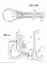 Fig. 11 - Method of performing a suprapubic transurethral cystostomy