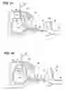 Fig. 14 - Method of performing a suprapubic transurethral cystostomy