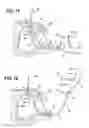Fig. 15 - Method of performing a suprapubic transurethral cystostomy