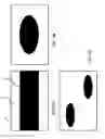 Fig. 03 - BALLOON CATHETER COMPRISING A RADIALLY ASYMMETRICALLY DILATABLE PORTION