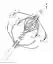 Fig. 06 - Percutaneous retrievable vascular filter