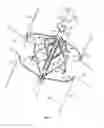 Fig. 12 - Percutaneous retrievable vascular filter