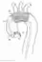 Fig. 01 - Embolic protection device