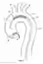 Fig. 03 - Embolic protection device