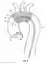 Fig. 05 - Embolic protection device