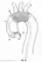 Fig. 06 - Embolic protection device