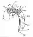 Fig. 01 - Embolic protection device