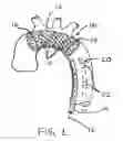 Fig. 02 - Embolic protection device