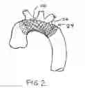 Fig. 03 - Embolic protection device