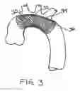 Fig. 04 - Embolic protection device