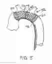 Fig. 06 - Embolic protection device