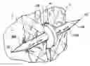 Fig. 01 - Wound closure device including barbed pins
