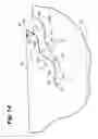 Fig. 09 - Wound closure device including barbed pins