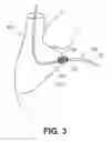 Fig. 04 - DEVICES, SYSTEMS, AND METHODS FOR CLOSING AN APERTURE IN A BODILY TISSUE