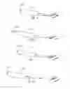 Fig. 03 - Closure device and method for sealing a puncture in a blood vessel