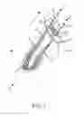 Fig. 02 - Suspensory graft fixation with adjustable loop length