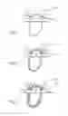 Fig. 03 - Suspensory graft fixation with adjustable loop length