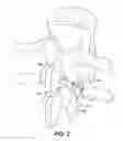 Fig. 03 - Facet device and method