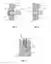 Fig. 03 - Spinous process implant with a post and an enlarged boss