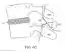 Fig. 10 - METHODS AND DEVICES FOR RESTRICTING FLEXION AND EXTENSION OF A SPINAL SEGMENT