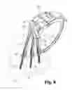 Fig. 10 - Low Profile Extension Attachments for Bone Anchors