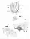 Fig. 09 - Vertebral column implant for stabilization and stiffening of vertebral bodies of a vertebral column