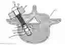 Fig. 01 - Removable anchoring pedicle screw