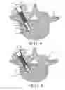 Fig. 04 - Removable anchoring pedicle screw