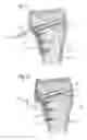 Fig. 06 - Bone anchoring device