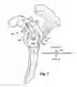 Fig. 06 - System and method for assisting with arrangement of a stock instrument with respect to a patient tissue