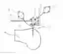 Fig. 01 - Reduced invasivity fixation system for trackers in computer assisted surgery