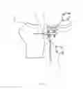 Fig. 04 - Reduced invasivity fixation system for trackers in computer assisted surgery