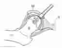 Fig. 01 - Hip joint instrument and method
