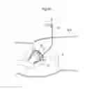 Fig. 29 - Hip joint instrument and method